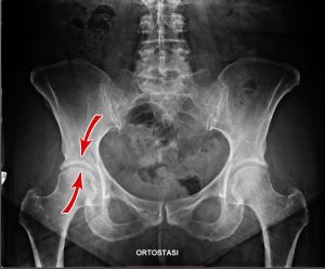 radiografia artrosi anca rieduca